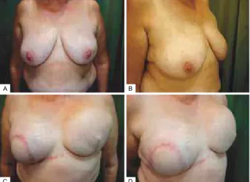 Figure 18 – Patient 14. Bilateral nipple–areolar complex  reconstruction, breast size adequacy, and valve removal