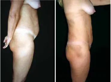 Figure 2 – Lateral view of pre- and postoperative  lipominiabdominoplasty.
