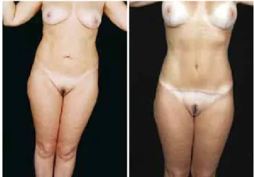 Figure 24 – Pre-and postoperative secondary  abdominoplasty with autonomization of the navel