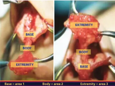 Figure 2 – In A, atrophic muscle. In B, normal muscle.  