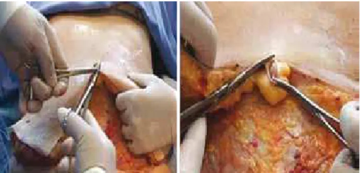 Figure 1 –  Isolation of the umbilical scar from the abdominal lap.