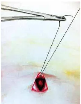 Figure 4 – Marking the lower base triangle in the proper projection  of the umbilical stump at the abdominal lap, and subsequent 