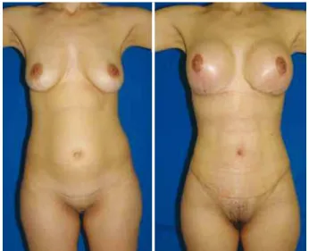 Figure 12 – Umbilicoplasty result (transoperative period).