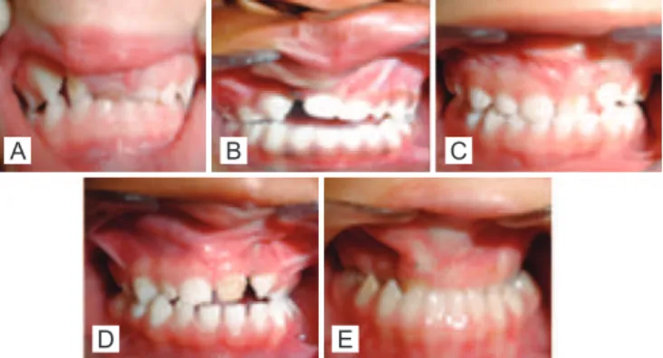 Figure 1 – Representation of categories or scores of the   Atack index in deciduous dentition (CADEFI)
