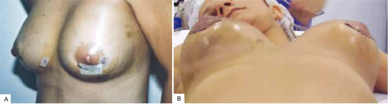 Figure 1 – A: Hematoma in the left breast. B: Bilateral hematoma on the thirteenth postoperative day of augmentation mammaplasty.