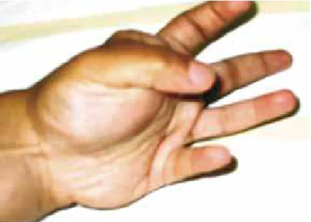 Figure 7 – Thumb clamping movement with the second inger,  observed during the preoperative period.