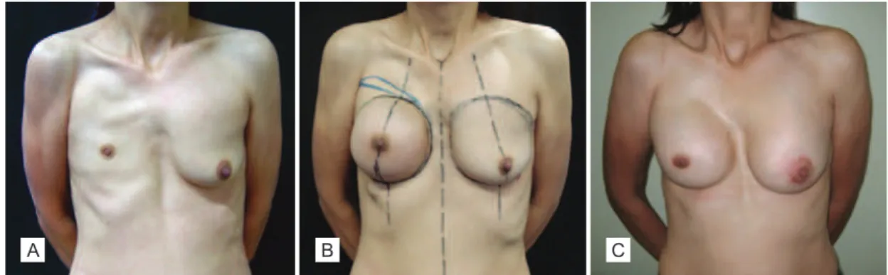 Figure 4 – Patient with Poland’s syndrome. In A, preoperative aspect. In B, appearance after placing the expander