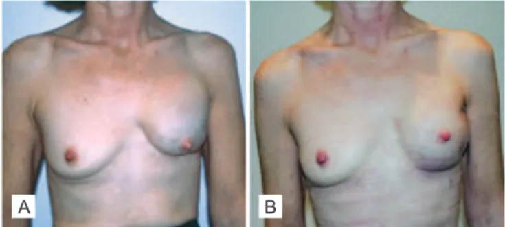Figure 5 – Patient who underwent breast reconstruction after  adenomastectomy, with placement of subpectoral breast prosthesis