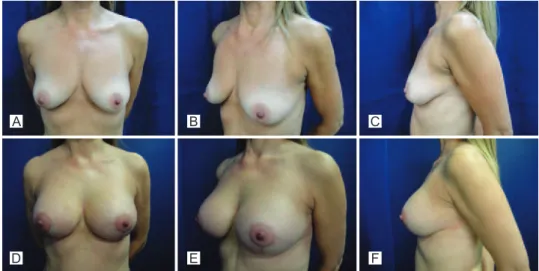 Figure 6 – Case 3. A to C, preoperative period. D to F, postoperative period of 9 months.ADBECFADBECF