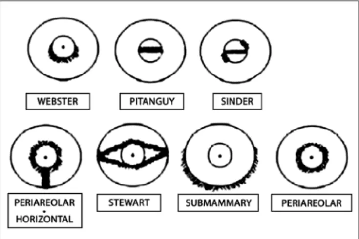 Figure 1 – Types of incisions for mammary gland access. 