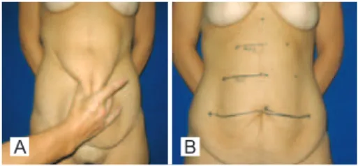 Figure 1 – A, marking of the cutaneous excess  by bi-digital clamping. B, marking of the area to 