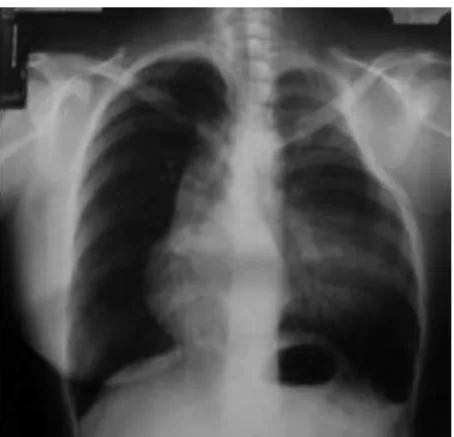 Figure 3 – Chest X-ray revealing a costal deformity on the left   and deviation of the mediastinum on the right