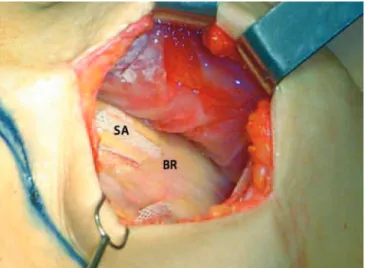 Figure 4 – The cavity after removal of the breast prosthesis.  