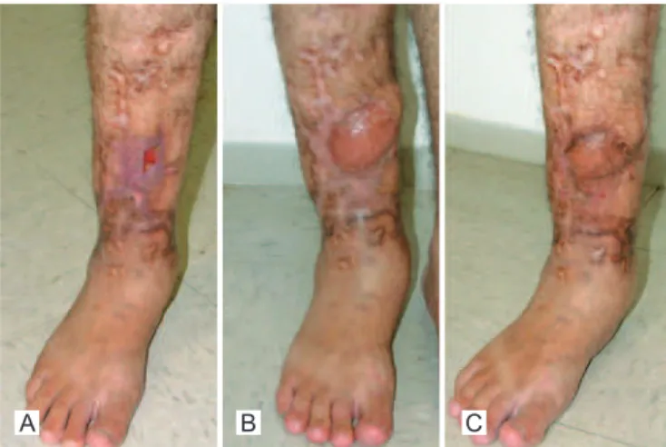 Figure 2 – Case 1. In A, preoperative period, revealing the  ulcerated lesion with bone exposure
