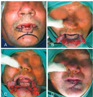 Figure 2 – Defect of up to 30% demonstrating the primary closure  technique in stages