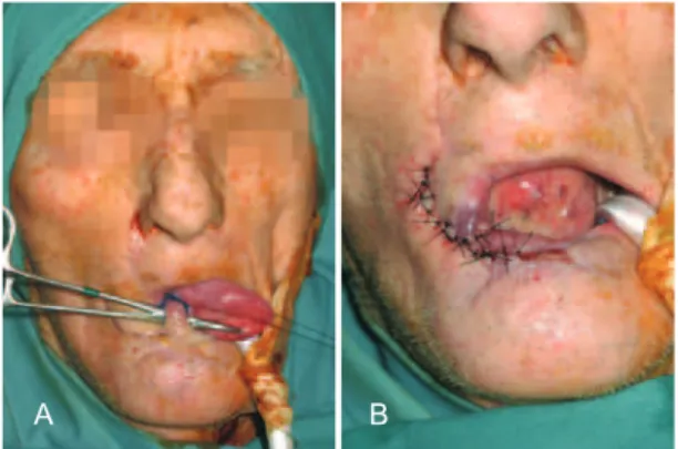 Figure 8 – Converse commissuroplasty used in cases in which the  commissure was affected