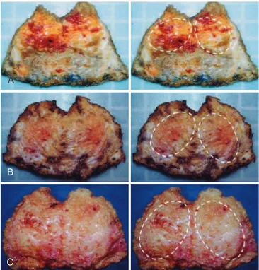 Figure 9 – Clamping of the supericial fascia laterally,   involving a fat purse.