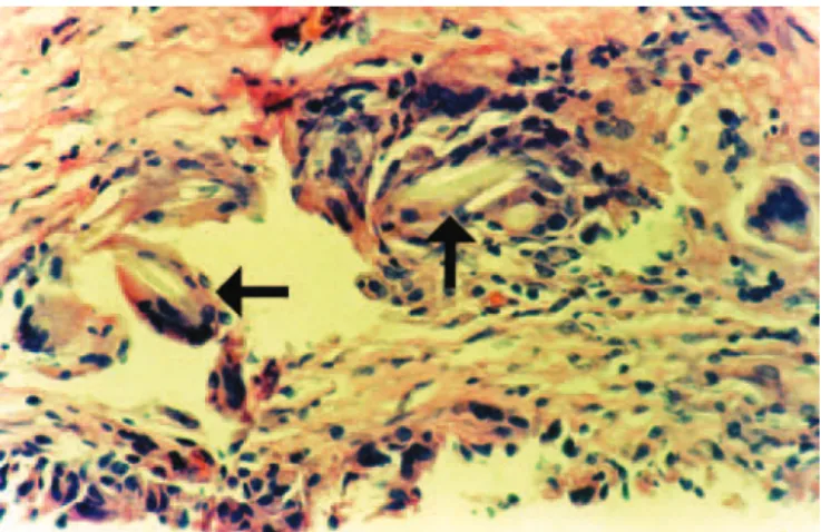 Figure 4 – Photomicrograph of a histological section showing  the capsule wall, with numerous foreign body-type giant cells  containing refringent material in their cytoplasm (foreign body) 