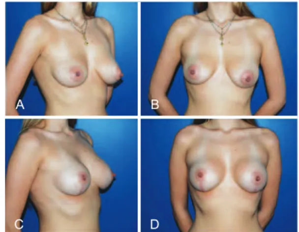 Figure 6 – Patient who underwent augmentation mastoplasty   with the inclusion of silicone implants associated with the   initial periareolar approach mastopexy