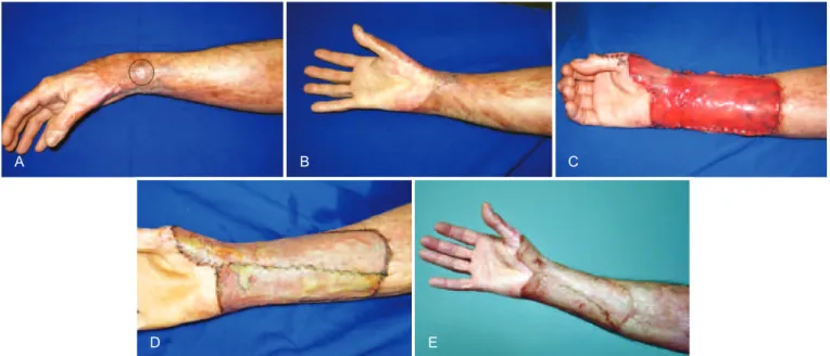 Figure 3 – In A, burn scar contracture in the upper limb. Notice the recurrent ulceration in the delimited area