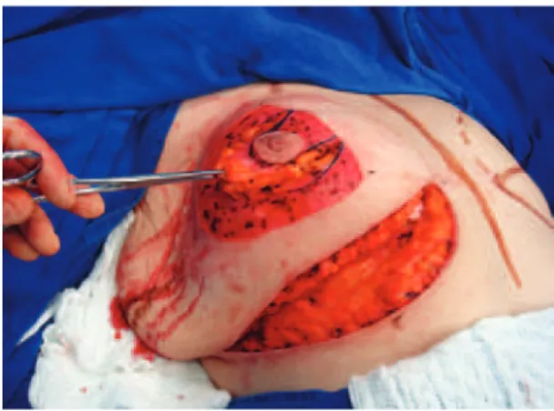 Figure 1 – Incision in the inframammary fold until   the muscle fascia is reached.