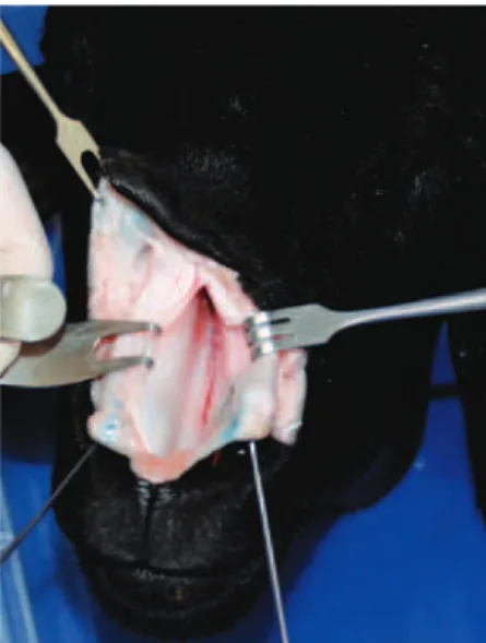 Figure 2 – Separating the medial crura and exposing   the caudal septum. 