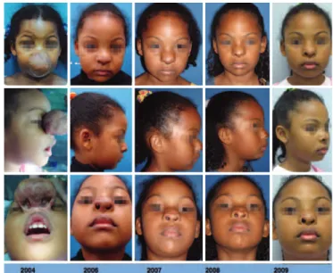 Figure 1 – Mixed infantile hemangioma in the   proliferative phase affecting the entire nose