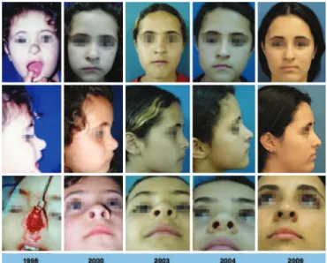 Figure 4 – Supericial infantile hemangioma in the   proliferative phase affecting the tip and dorsal sides of the nose