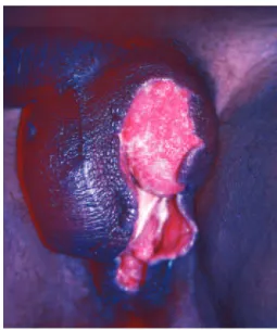 Figure 2 – In A and B, exposed testicles before reconstruction   of the scrotal sac.