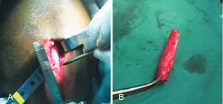 Figure 1 – In A, donor area in the forearm. In B, bone graft.