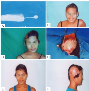Figure 4 – In A, tissue expander. In B, partial scalping after  grafting (previous view)