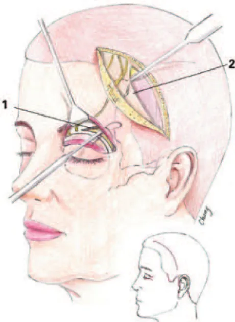 Figure 5 – Temporofrontal blepharoplasty and facial incisions.  