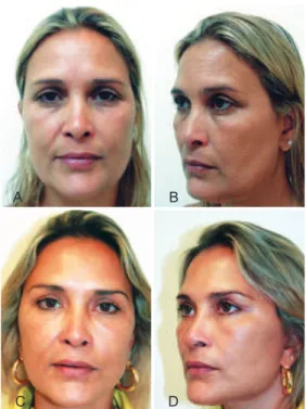 Figure 10 – In A and B, preoperative appearance in the frontal   and proile views, respectively