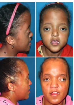 Figure 3 – Patient with Apert syndrome. In A and B, lateral and  front views, respectively, preoperatively frontofacial monobloc  advancement, showing hypoplasia of the periorbital region and  retrusion of the midface
