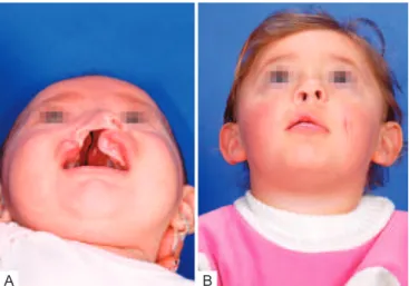 Figure 12 – In A , Preoperative appearance of a patient with complete left cleft lip and palate