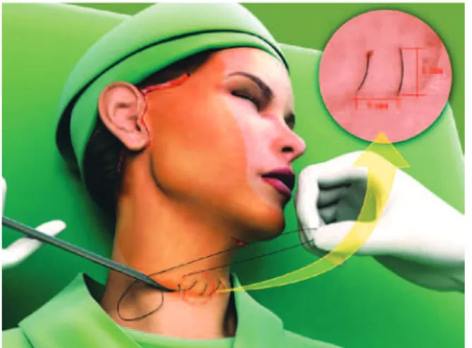 Figure 1 – The hemostatic net started at the lowest point   at the base of the neck, ensuring a distance of 1 cm between  