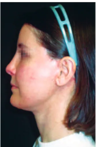Figure 9 – Patient on the eighth postoperative day. Most of the  needle entry points are already completely epithelialized.