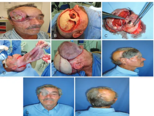 Figure 2 – Case 7. In A, squamous cell carcinoma in the   biparietal region. In B, late postoperative appearance after 