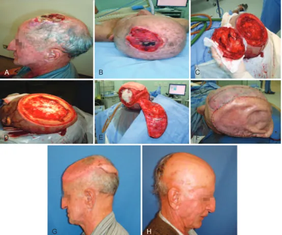 Figure 4  – Case 14. In  A , squamous cell carcinoma in the left parietal region. In  B , panoramic view of ulcerative-iniltrative lesions