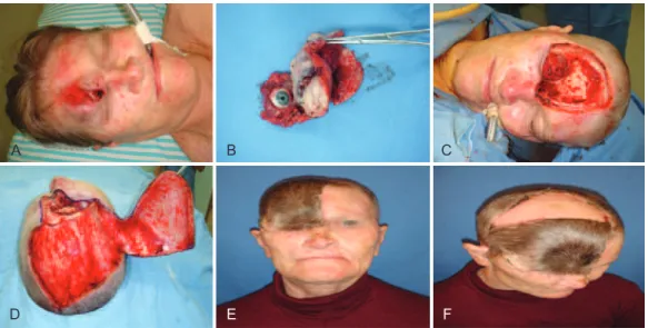 Figure 8 – Case 24. In A, squamous cell carcinoma in the right fronto-orbital region. In B, image of the surgical specimen   upon monoblock resection