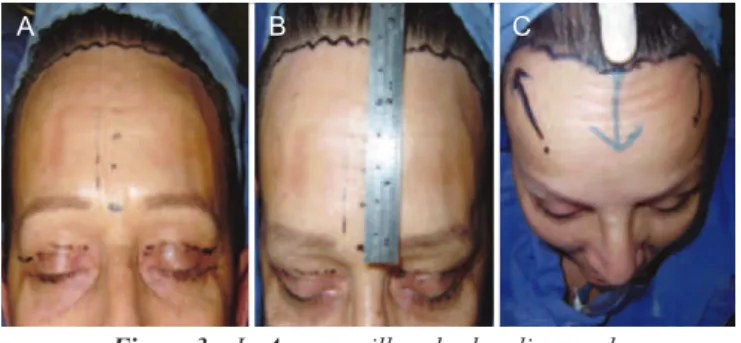 Figure 4 – Effect of hair follicle orientation in   a visible scar with beveled incision
