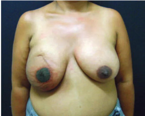 Figure 9 – Late result in a nipple-areolar complex   of intermediate color.
