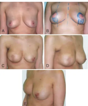 Figure 7 – 1 year post-operative result of right skin reducing  mastectomy and alloplastic reconstruction with simultaneous  contralateral circumvertical mastopexy