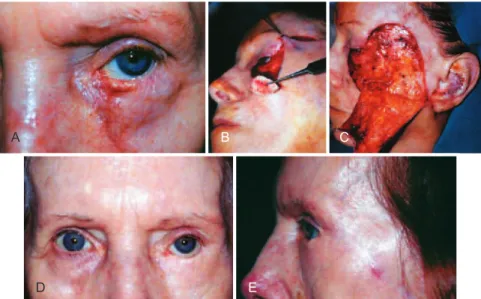Figure 1 – In A, basocellular carcinoma affecting the left lower eyelid. In B, conchal cartilage graft from the left ear