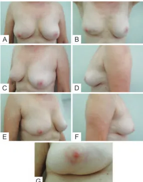Figure 4 – Examples of assessment for the Moro &amp; Ciambellotti  classiication. In A and B, patients with aesthetic results considered 