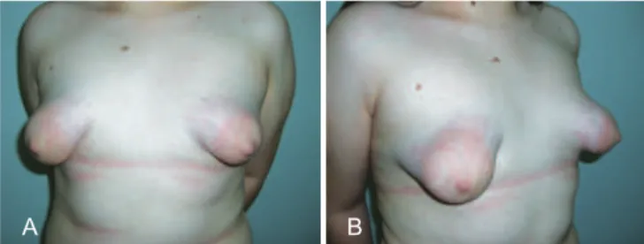 Figure 1 – A and B, tuberous breasts with hypoplasia of the  mammary parenchyma and herniation through the extended   nipple-areolar complex in frontal and proile views, respectively.