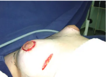 Figure 7 – Immediate postoperative appearance,   showing combined incisions and placement of  