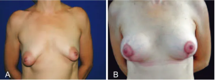 Figure 12 – In A , preoperative appearance of a patient with  asymmetrical tuberous breasts with sagging skin and stretch   marks as well as slight left and moderate right breast ptosis