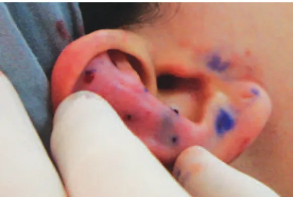 Figure 1 – Guide-points: methylene blue tattoos on the   skin and cartilage served to guide accurate application  