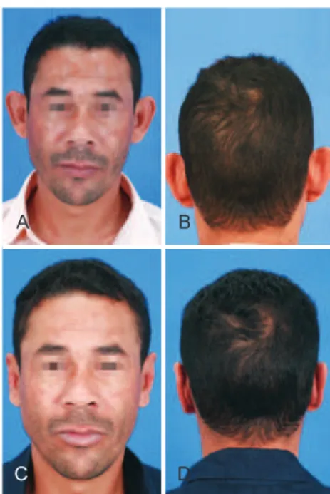 Figure 15  – Patient in the classic group. In  A  and  B ,   preoperative appearance. In C and D, postoperative appearance.